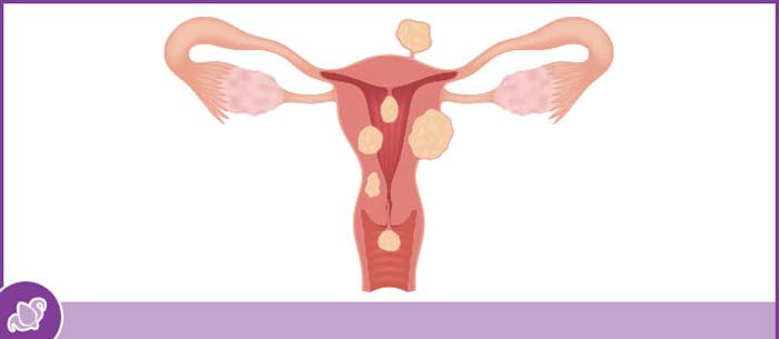 Myomectomy Surgery Specialist Near Me in Austell, GA Myomectomy Surgery Specialist Near Me in Austell, GA