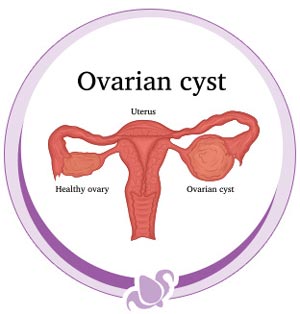 Removal of Ovaries or Cysts Specialist Near Me in Austell, GA