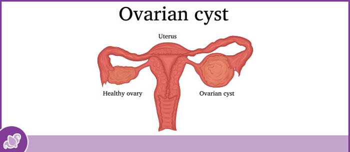 Ovarian Cystectomy Specialist Near Me in Austell, GA