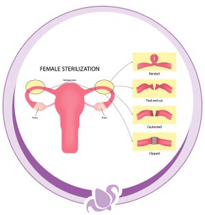 Tubal ligation Procedure Near Me in Austell, GA