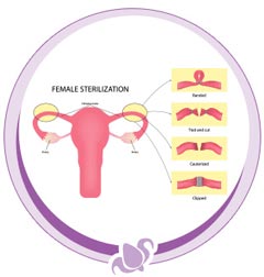 Tubal ligation Procedure Near Me in Austell, GA